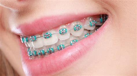 what is omni metal dental brackets|metal orthodontic braces.